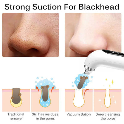 Blackhead Remover Pore Vacuum WEM Support (www.WEM.support)