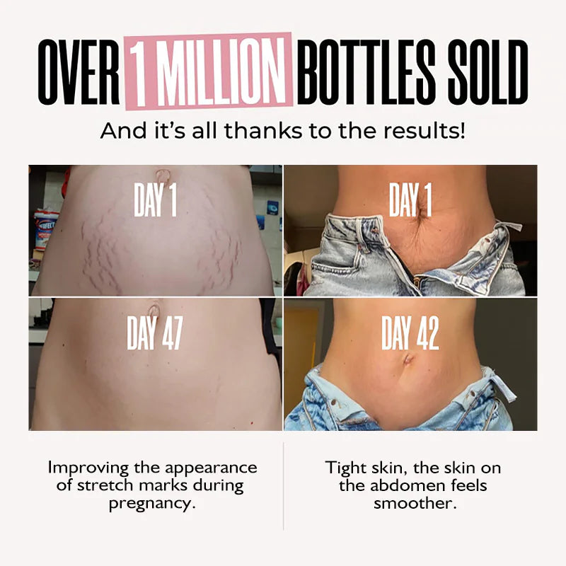 Stretch Mark Removal Cream WEM Support (www.WEM.support)